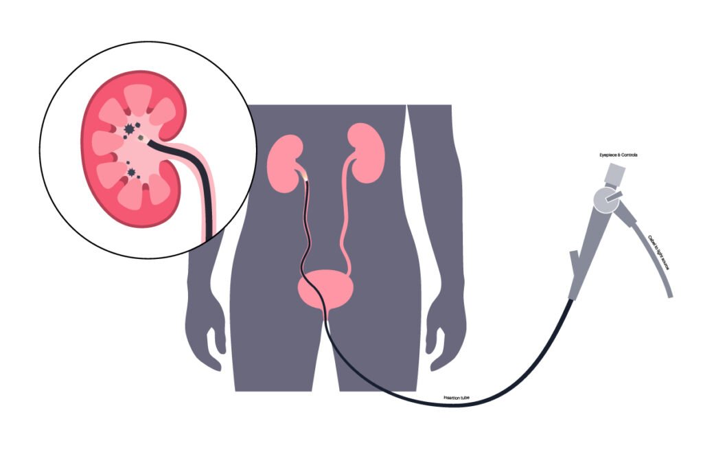 Suction Technology is Transforming Kidney Stone Treatment